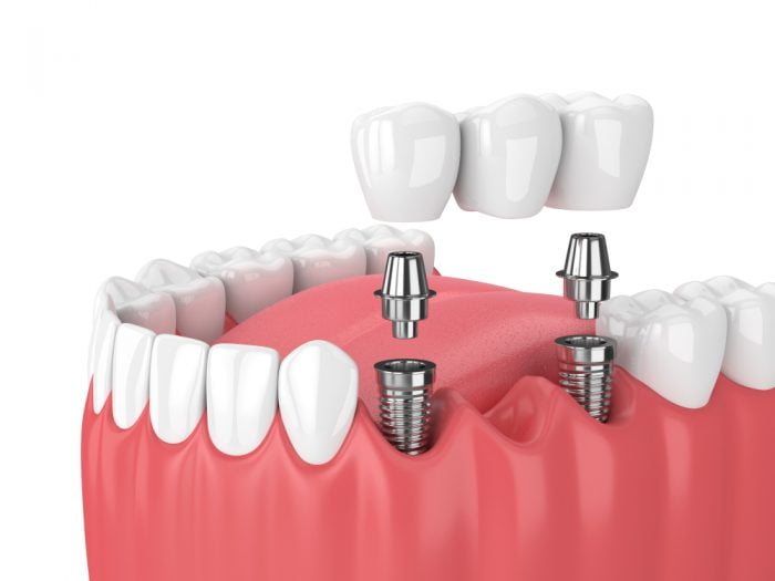 Restoration Of Missing Teeth Dental implants Pinner Road Dental